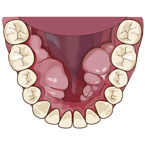 お口の中に出来るコブ骨隆起とは 保土ヶ谷の歯科 エミデンタルクリニックの新着情報